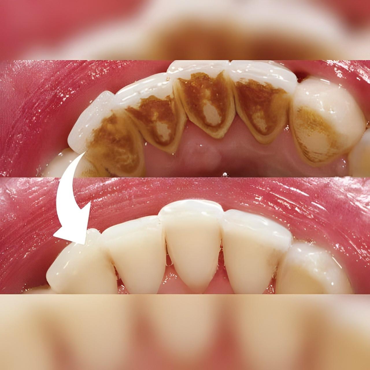 Skaler Dentystyczny Do Pielęgnacji Zębów – Wodoodporny, 5 Poziomów Intensywności 5