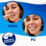 Fornir Uśmiechowy do Poprawy Uśmiechu - Trwałe Licówki, Medyczna Jakość, Idealne Dopasowanie  9